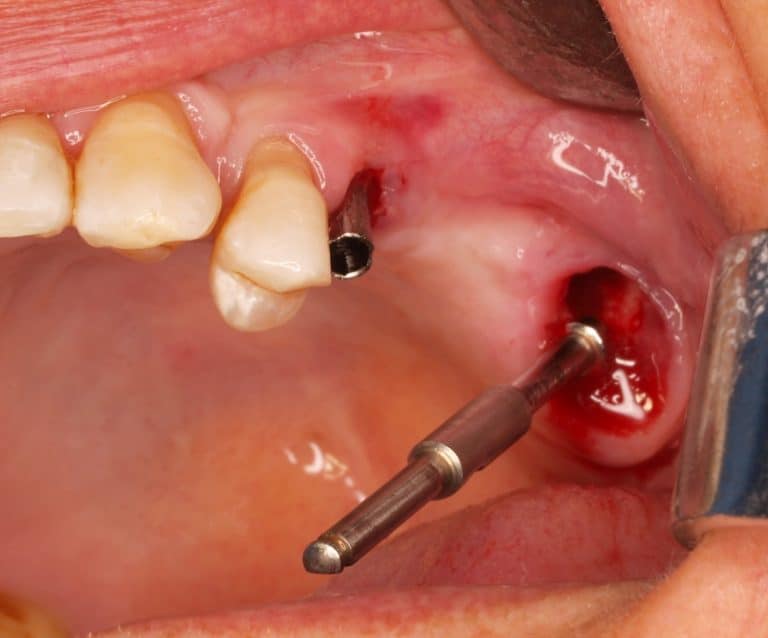 Implants placed with an angle of 45º avoiding entering the maxillary sinus.