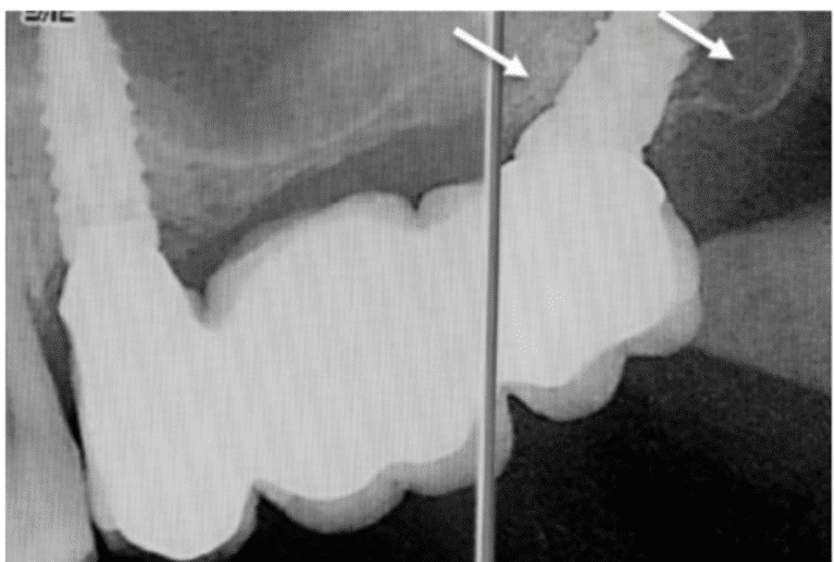 Bone level preservation and good osseointegration are observed at 24 months post-implant placement.