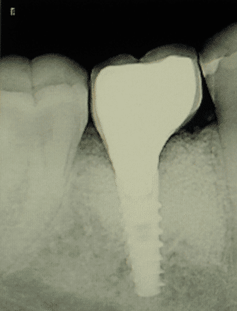 1 YEAR AFTER BONE GRAFTING Maintenance of both bone level and osseointegration of the implant.