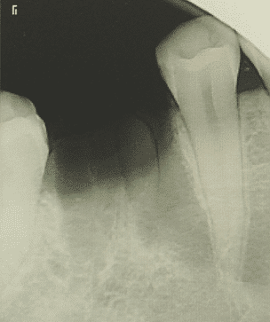 The extraction leaves a bone defect of the whole alveolus area.